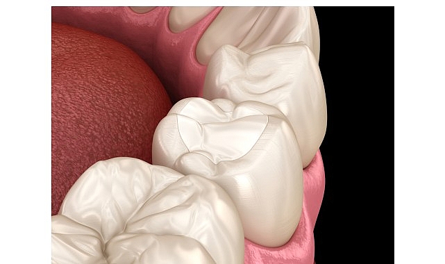 estetik dolgularin omrunu aliskanliklarimiz belirliyor