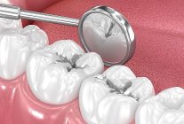 amalgam dolgular degistirilmeli mi