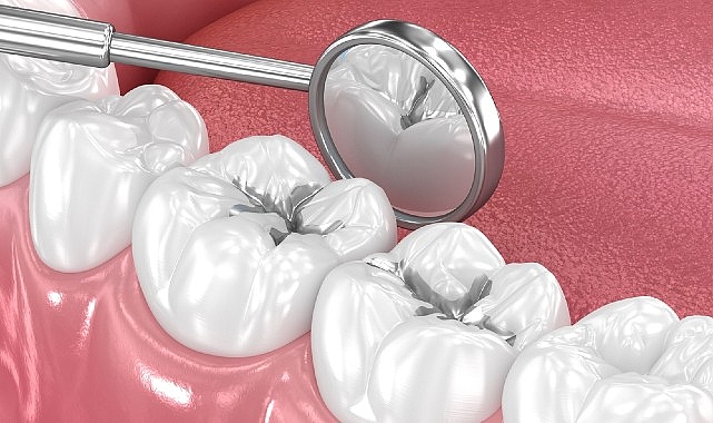 amalgam dolgular degistirilmeli mi